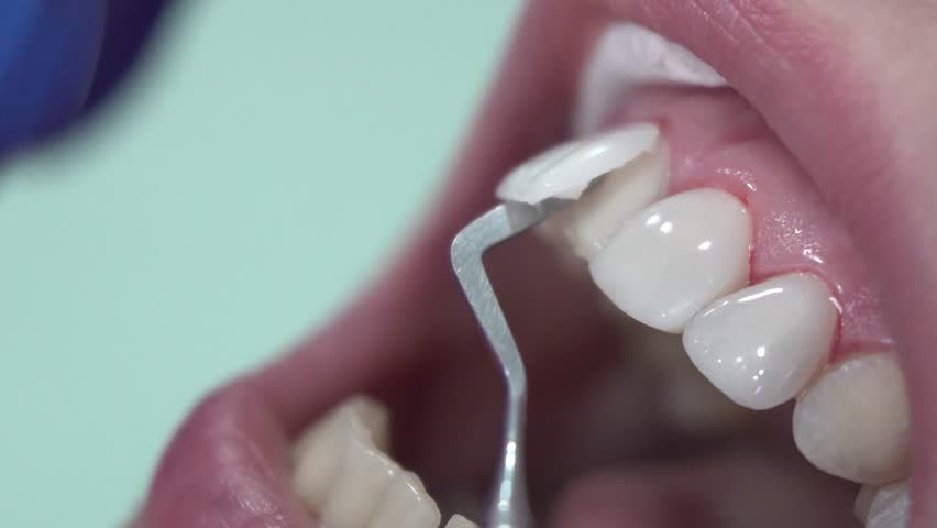 3 Types of Dental Veneers