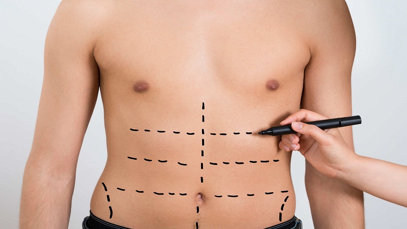 Vital Points about the Liposuction Surgery