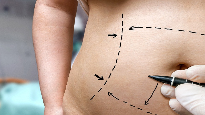 4 Things to Know about Liposuction